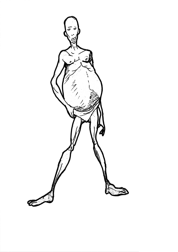 1533977965-7cc08c1182fe564c9cfd582011d942de4fd2d79e-yemba-avoir-le-kwashiorkor.png